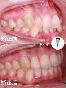 长春净月区儿童、青少年及成年人牙齿正畸优质服务推荐,聚焦专业诊疗体验