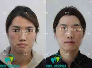 长春青少年及成年人牙齿矫正服务推荐：二道区优质正畸门店大揭秘