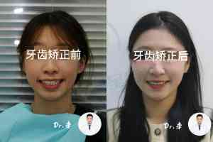长春净月区青少年牙齿矫正与清洗服务推荐，专业机构为您护航
