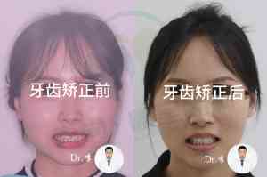 长春净月区牙齿正畸服务推荐:儿童、青少年及成年人正畸优质之选