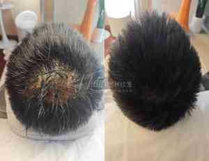 邢台植发区修复、北京疤痕修复等多地纹发服务及方案优质推荐