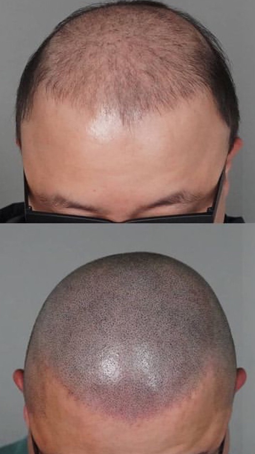 露顶记纹发
